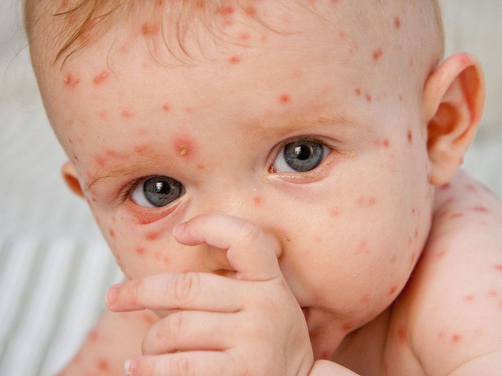 chickenpox-1