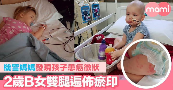 機警媽媽發現孩子患癌徵狀  2歲B女雙腿遍佈瘀印