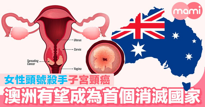女性頭號殺手子宮頸癌     澳洲有望成為首個消滅宮頸癌國家