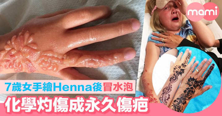 7歲女手繪Henna後冒水泡 化學灼傷成永久傷疤