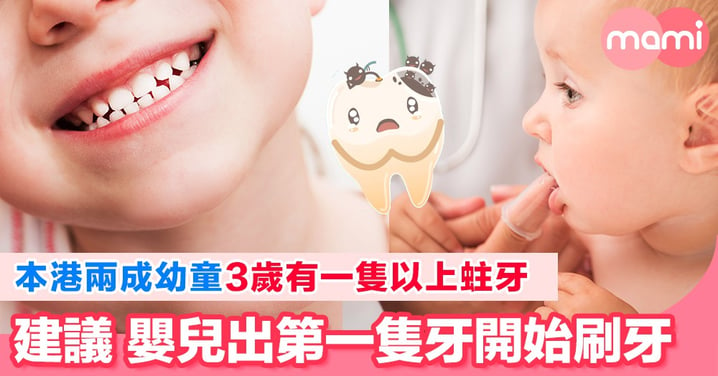 本港兩成幼童患蛀牙3歲有一隻以上蛀牙 專家建議嬰兒出第一隻牙開始刷牙 兩成幼童患蛀牙蛀前排門牙　建議嬰兒6個月大開始刷牙