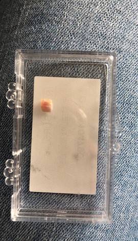 4EC9F76500000578-6022791-The_tooth_was_present_but_incredibly_loose_because_the_gum_line_-a-32_1533309136895-1