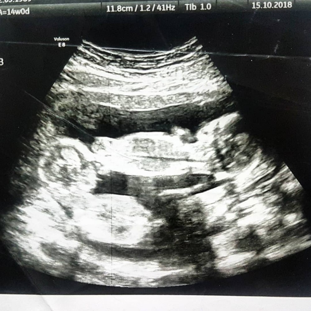 媽媽堅信BB生命力2姊妹出世後互相抱緊