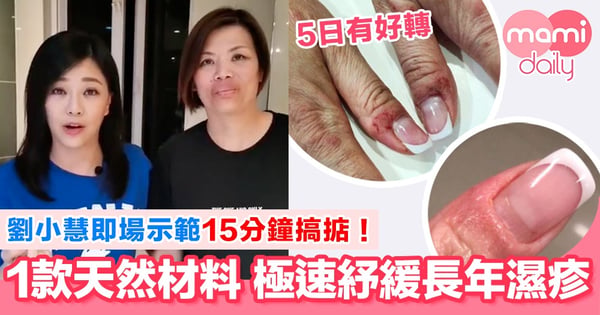 真人真事！劉小慧開心分享紓緩嚴重濕疹配方