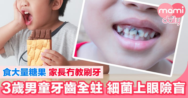 愛吃糖果懶刷牙 3歲男童牙齒全蛀 細菌上眼險盲