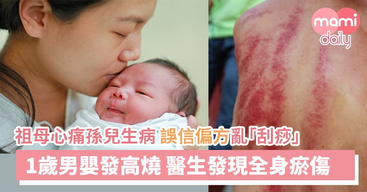 1歲男嬰發高燒 祖母偏方「刮痧」致周身瘀傷
