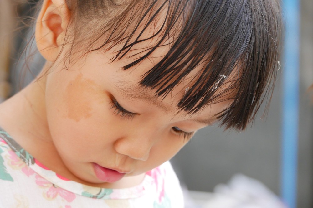 胎記可分為先天成型或後天成型