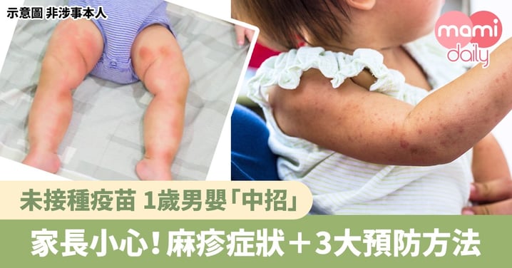 【麻疹】1歲男嬰染麻疹！家長必睇 麻疹症狀＋3大預防方法