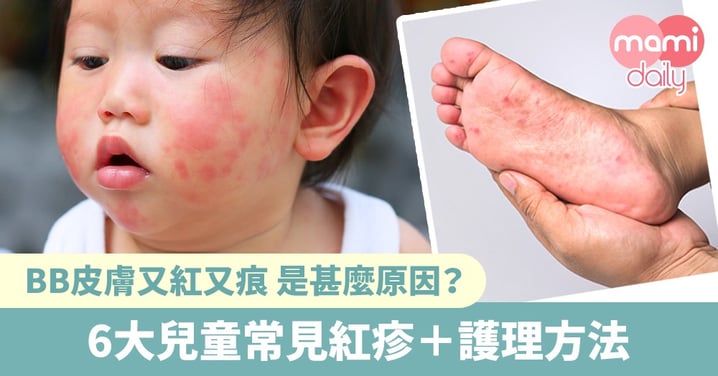 【紅疹】BB皮膚又紅又痕？家長必知 6大兒童常見紅疹