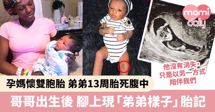 孕媽懷雙胞胎 弟弟13周夭折 哥哥出生後腿上現「弟弟樣子」胎記