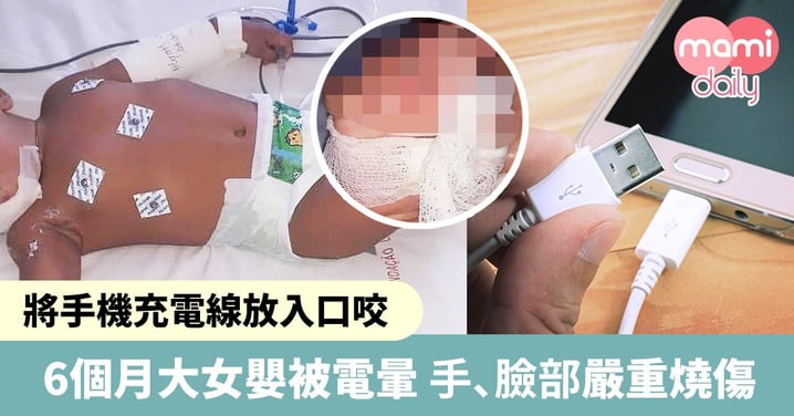 將手機充電線放入口咬 6個月大女嬰被電暈 臉部、右手嚴重燒傷 留醫ICU