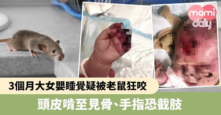 【老鼠咬人】3個月大女嬰睡覺疑被老鼠狂咬　頭皮啃至見骨、手指恐截肢