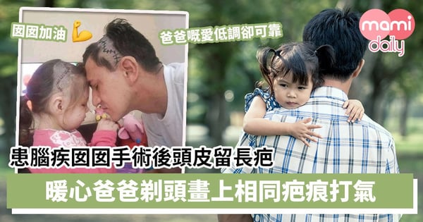 【父愛如山】患腦疾囡囡手術後頭皮留長疤　暖心爸爸剃頭畫上相同疤痕打氣