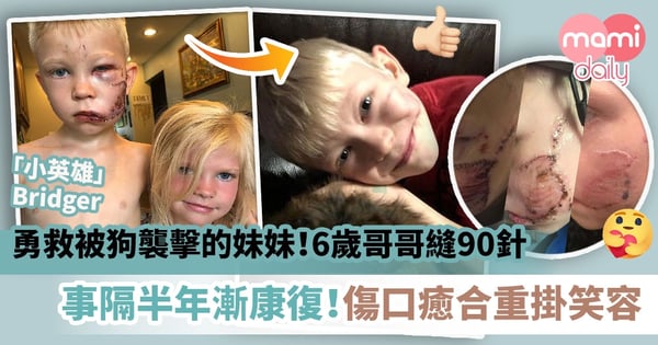 【小英雄】勇救被狗襲擊的妹妹！6歲哥哥縫90針　事隔半年漸康復！傷口癒合重掛笑容