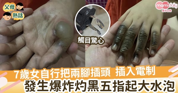 【家居安全】7歲女把兩腳插頭插入電制 發生爆炸灼黑五指起水泡