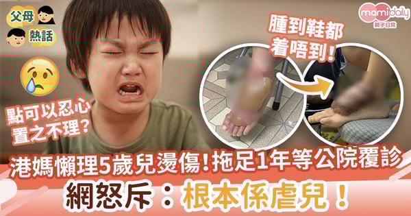 【幼兒燙傷】港媽懶理5歲兒燙傷！拖足1年不治療等公院覆診　網怒斥：根本係虐兒！