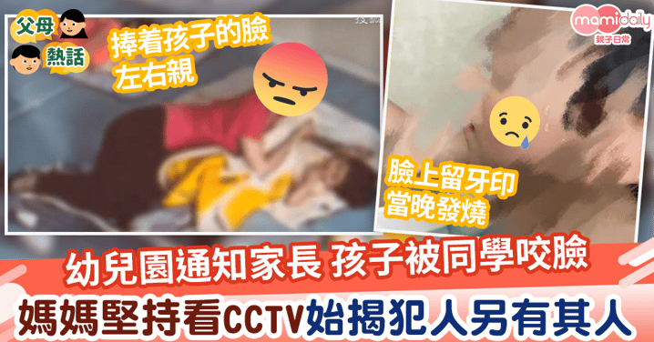 【令人髮指】女幼師通知家長孩子被同學咬臉留牙印 媽媽堅持翻看CCTV始揭犯人另有其人
