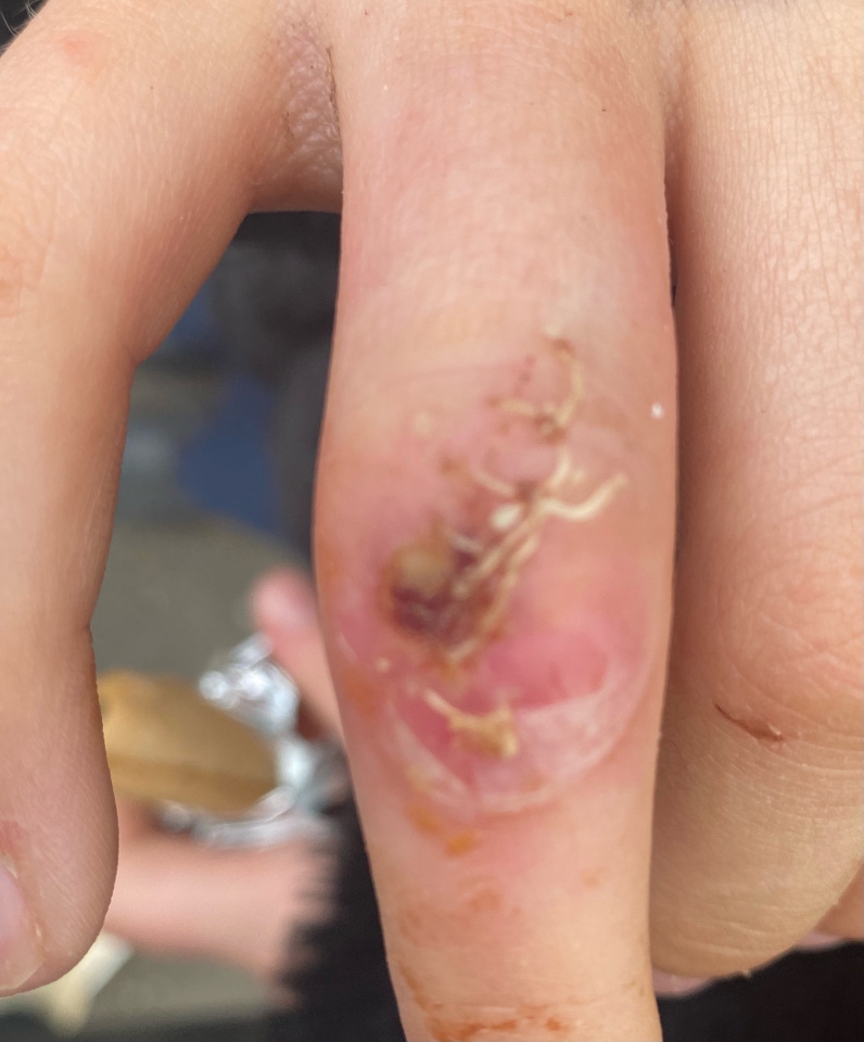 傷口出現腫脹疼痛，而且手臂更長了紅色皮疹