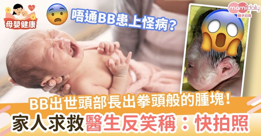 怪病 出世頭部異常地長 家人焦急求救醫生笑稱 快拍照 Mamidaily 親子日常