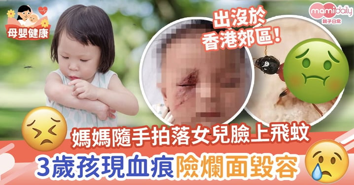 【危險蚊蟲】媽媽隨手拍落女兒臉上飛蚊　3歲孩現5cm血痕險爛面毀容