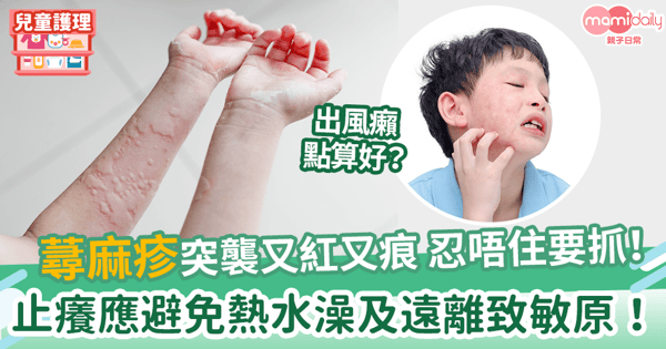 【風癩】蕁麻疹突襲又紅又痕 忍唔住要抓！　止癢應避免熱水澡及遠離致敏原！