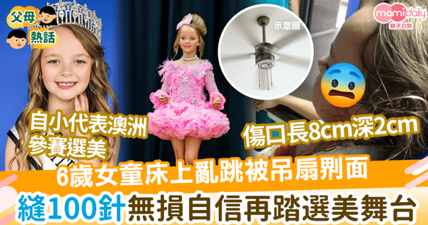 【家居意外】6歲女童上格床蹦蹦跳遭吊扇?面　花3小時縫100針無損自信再踏選美舞台