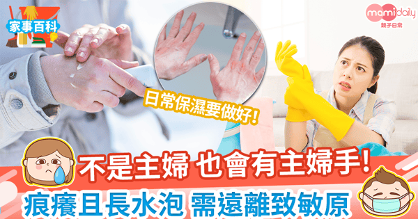 【主婦手特徵】痕癢且長水泡點算好? 一文睇主婦手原因、預防及治療方法