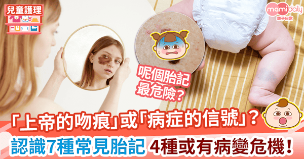 【嬰兒胎記】BB為何天生有胎記？　認識7種常見胎記 4種或有病變危機！　