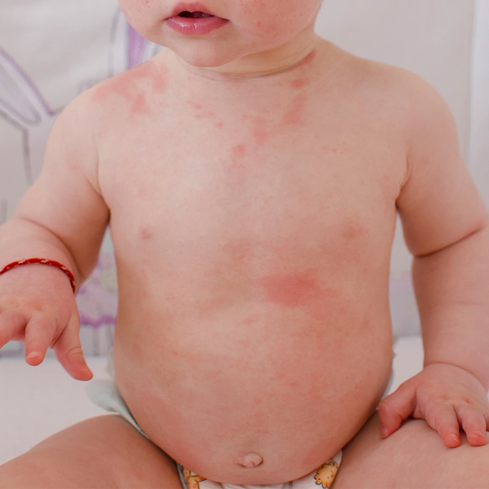 玫瑰疹（Roseola infantum）是由病毒引起的常見疾病，孩子身上可能出現細小的粉紅色或玫瑰色斑疹或丘疹，通常是扁平的