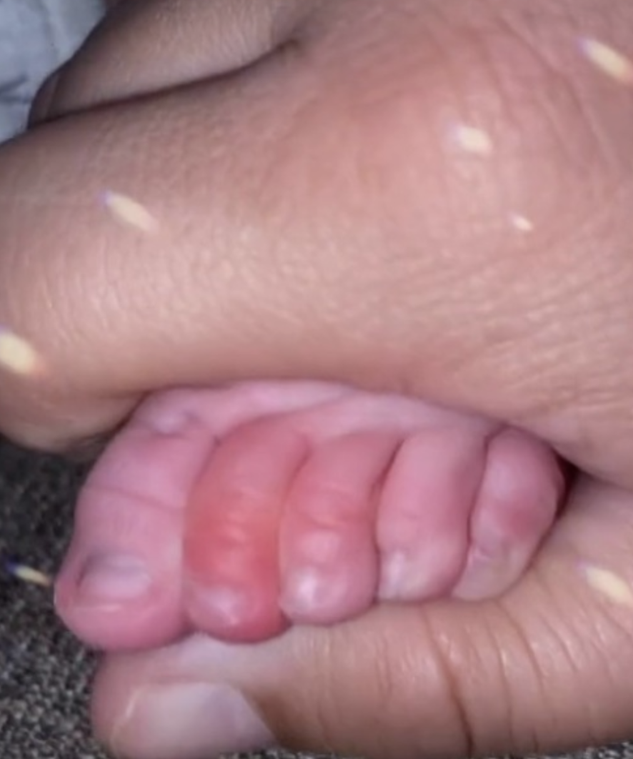 當小朋友的身體部位被頭髮緊緊纏住後,就會出現缺血的情況。