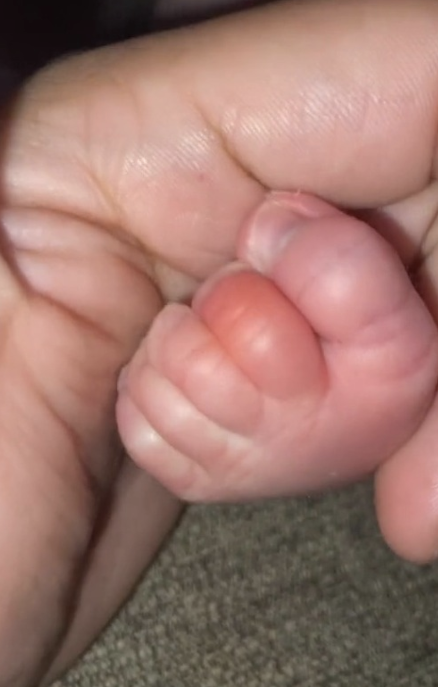 媽媽發現BB的其中一隻腳趾變得通紅腫脹,驚覺孩子的腳趾被一根頭髮纏住了。