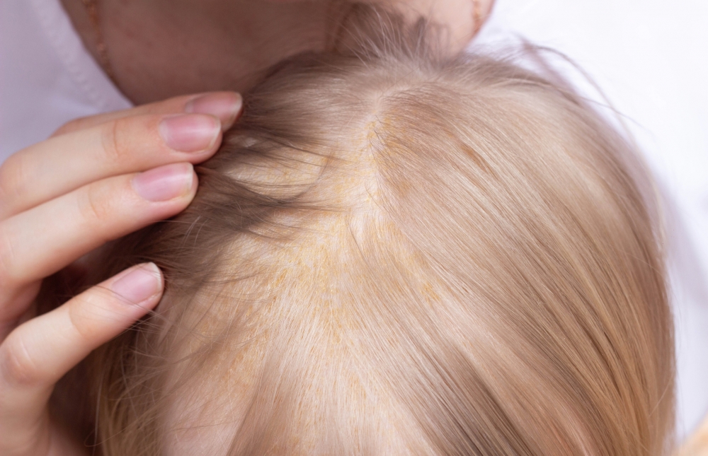 脂溢性皮膚炎出現在嬰兒頭部、前額、面頰、眼眉、耳朵、腋下、腹部、股溝和大腿間的皺摺部位,