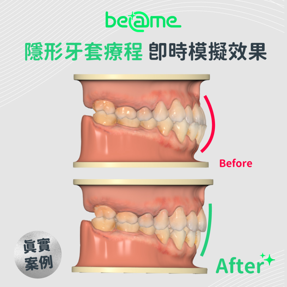 箍牙前後的模擬效果
