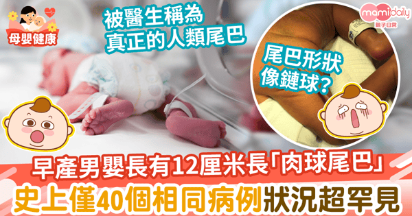 【嬰兒尾巴】早產男嬰臀部長出12厘米長肉球尾巴　人類史上僅40相同病例狀況超罕見