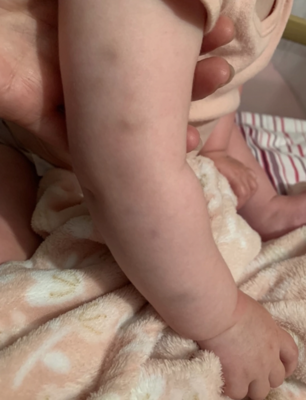 女童身上出現莫名的瘀傷，而且越來越嚴重。