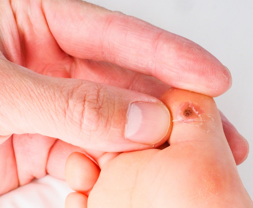 疣最大特點是中間有黑點。