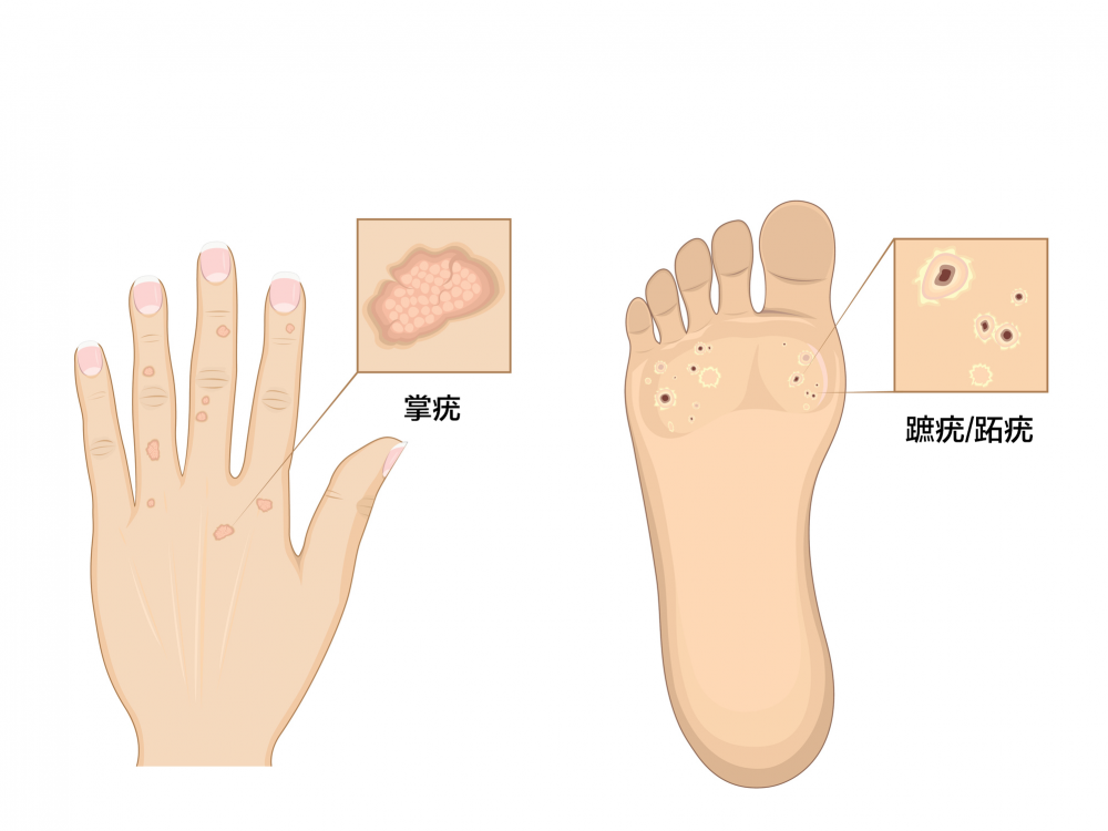 疣是由人類乳突病毒（HPV）引起，有傳染性。