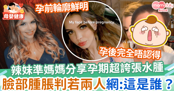 【孕期水腫】辣妹準媽媽分享孕期超誇張水腫　臉部腫脹判若兩人