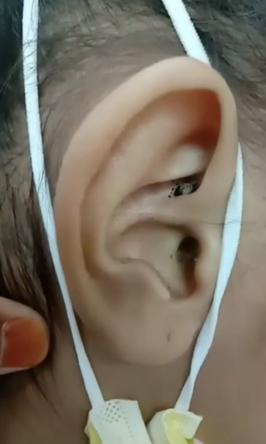 後來牛蜱成功被移除,也證實而我哪沒有其他牛蜱,讓母親鬆一口氣。