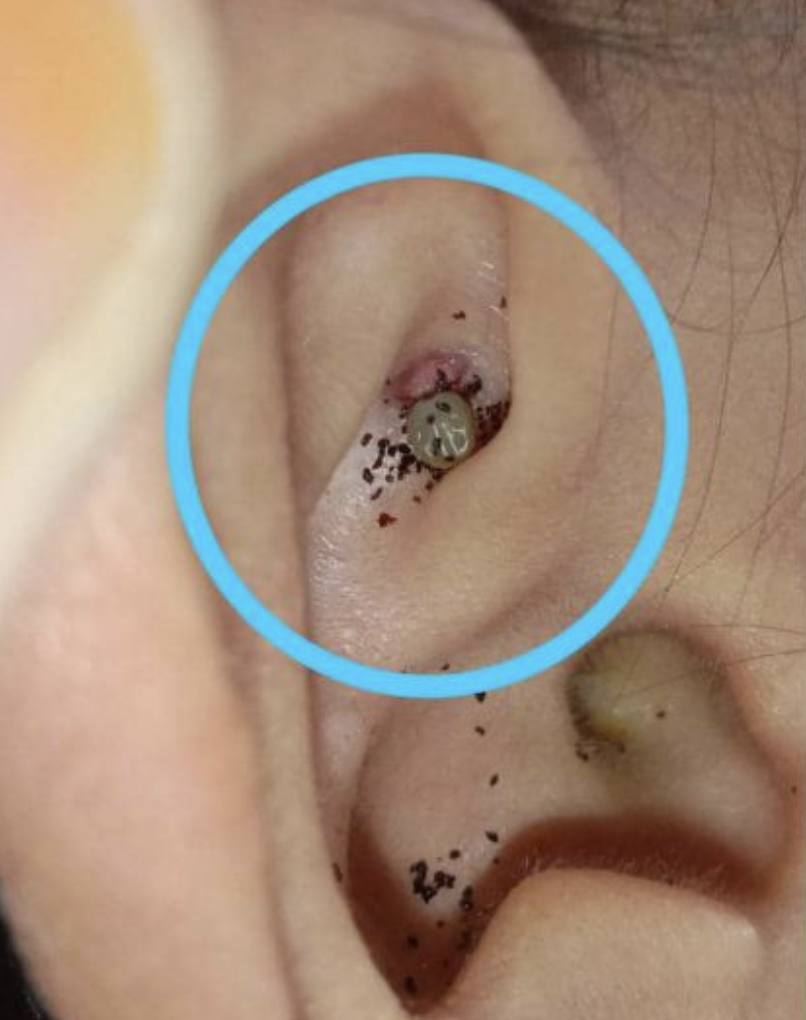 大馬一6歲男童耳朵內竟藏了一隻牛蜱!