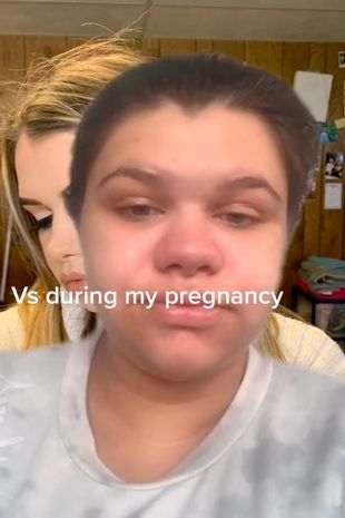 孕懷後期水腫得判若兩人。