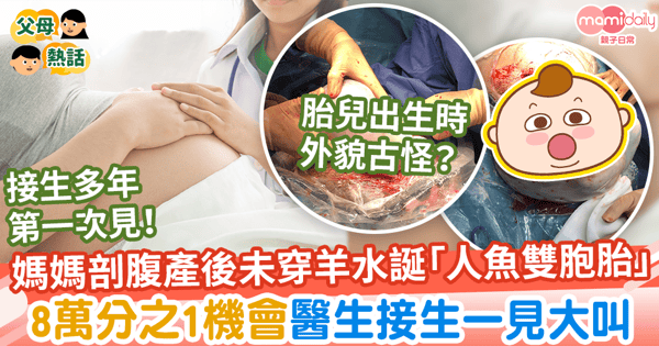 【人魚寶寶】媽媽剖腹產後仍未穿羊水誕「人魚雙胞胎」　8萬分之1機會醫生接生一見大叫