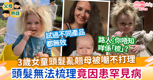 【頭髮似打風】3歲女童頭髮亂翹母被嘲不打理  頭髮無法梳理竟是因患罕見病