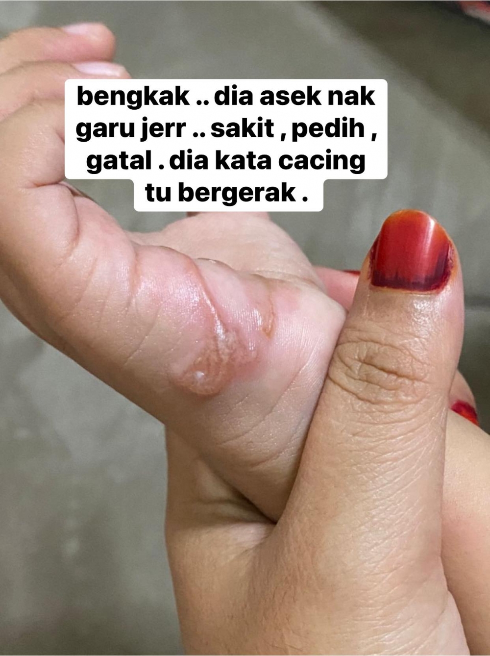 吃了第一位醫生開的藥後,患處沒有好轉,甚至還惡化。