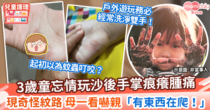 【皮膚感染】3歲童玩沙後手掌痕癢腫痛　母一看嚇親「有東西在爬」揭寄生蟲感染
