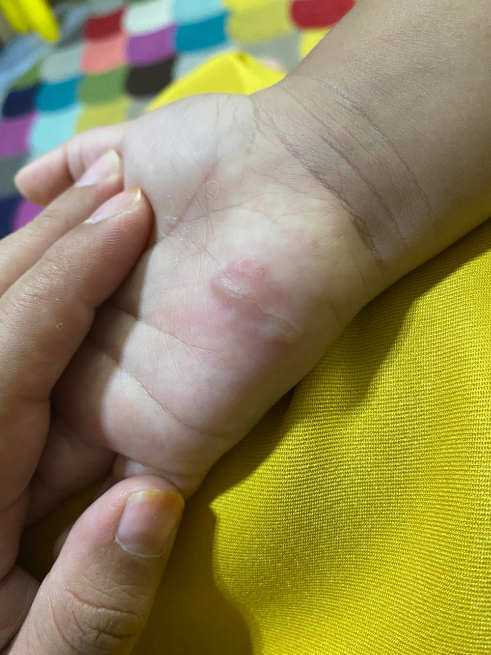 3天後患處開始紅腫、發癢及疼痛。