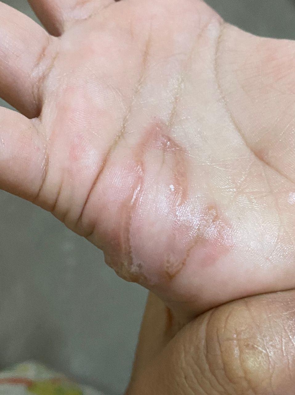 患處可以明顯看見條狀物體。