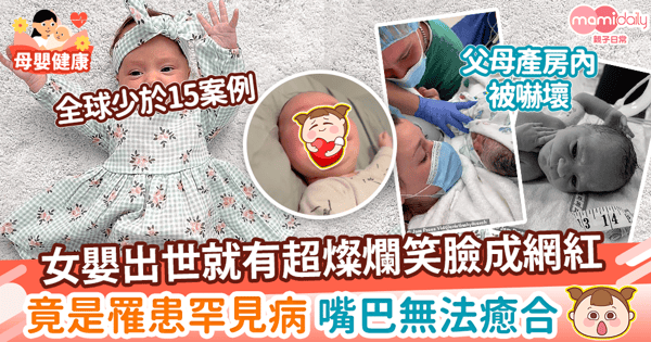 【罕見遺傳病】女嬰出生就擁有超燦爛笑臉成網紅　竟是罹患罕見病 嘴巴無法癒合