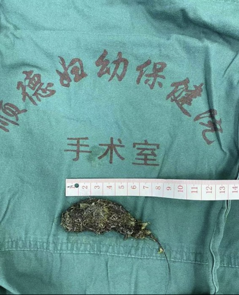 女童胃部取出的頭髮團長約8厘米。