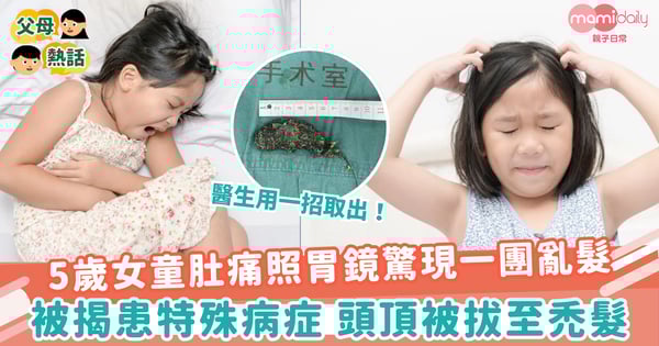 【怪癖】5歲女童肚痛照胃鏡驚現一團亂髮　被揭患特殊病症 頭頂被拔至禿髮